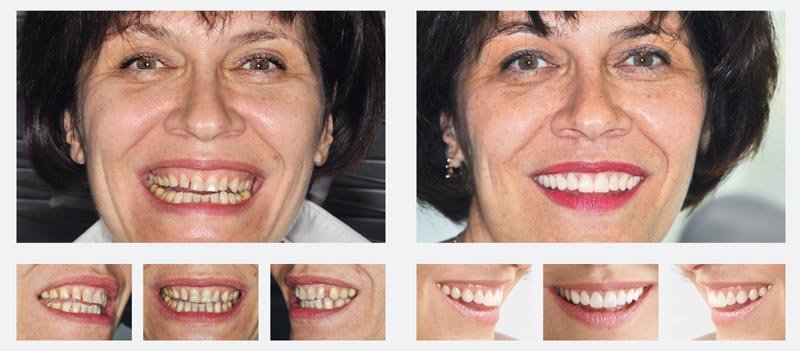 Veneers vorher nachher