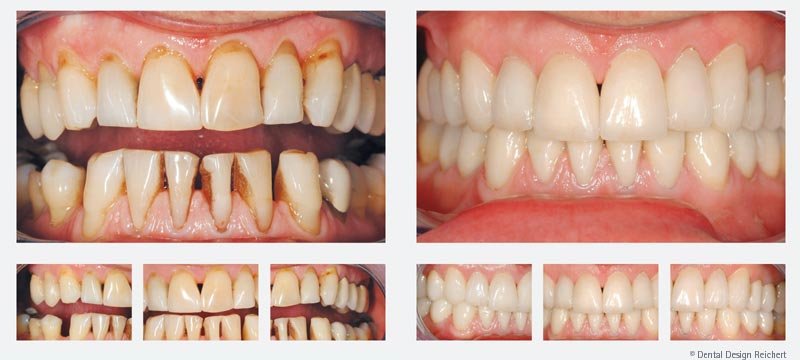 Veneers vorher nachher